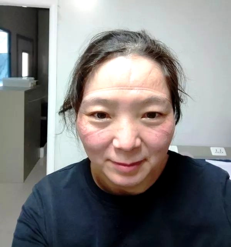 沈来红脸上被口罩、护目镜勒出的深深痕迹.jpg